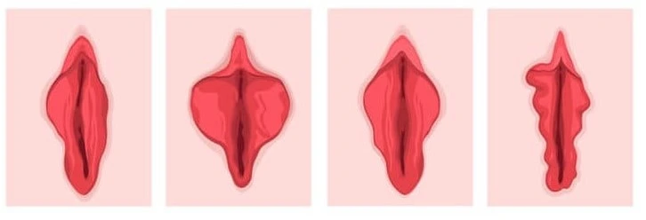 Elle Sante Cosmetic & Reconstructive Gynaecology Labia Hypertrophy