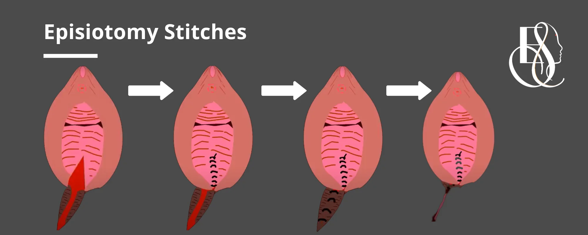 Episiotomy Stiches - Elle Sante Reconstructive & Cosmetic Gynaecology