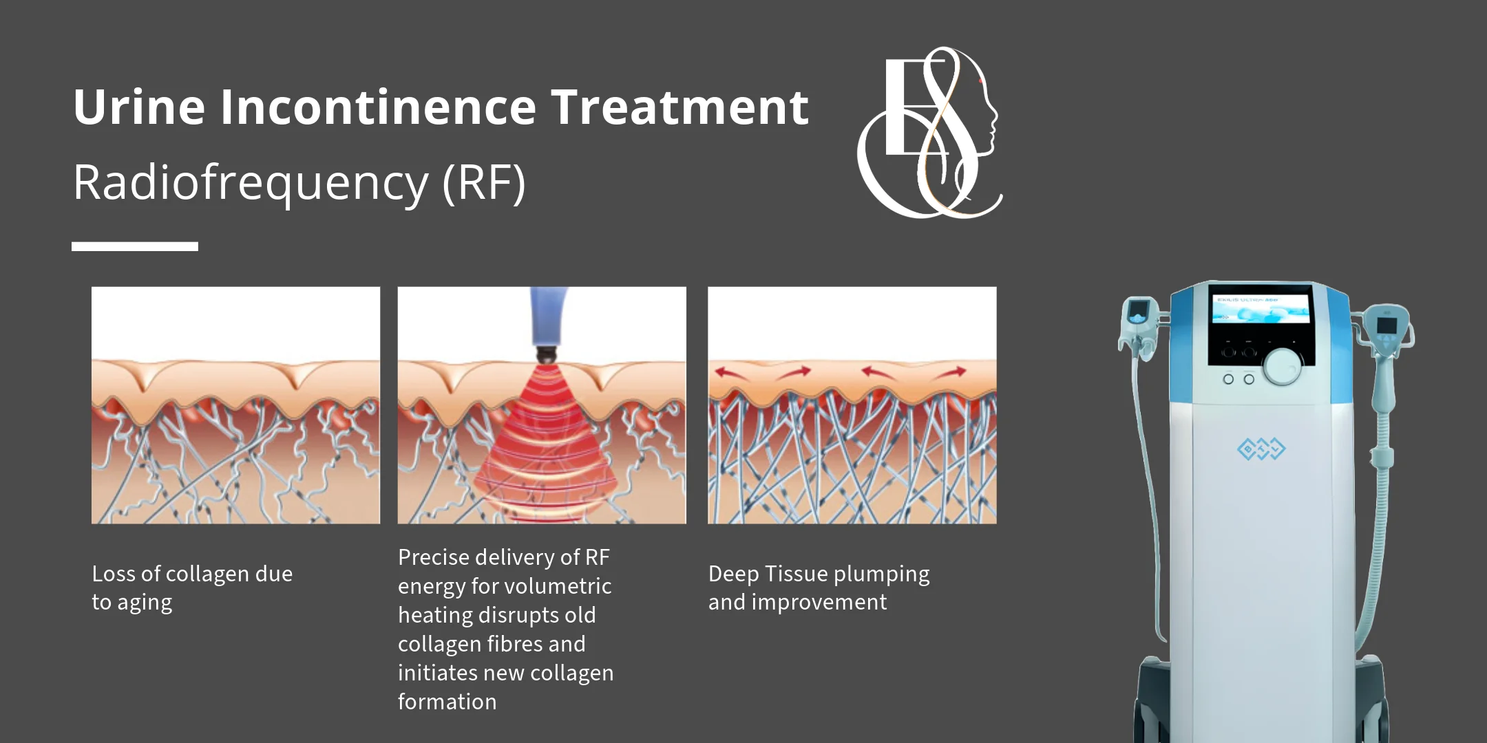 Urine Incontinence Treatment with RF, Elle Sante Reconstructive & Cosmetic Gynaecology