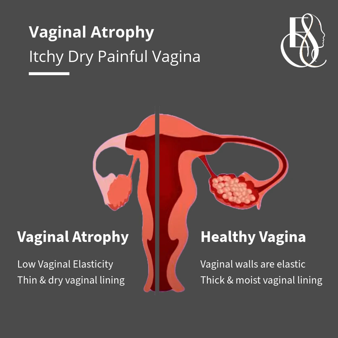 Vaginal Atrophy, Dry Itchy Vagina, Elle Sante, Reconstructive & Cosmetic Gynaecology