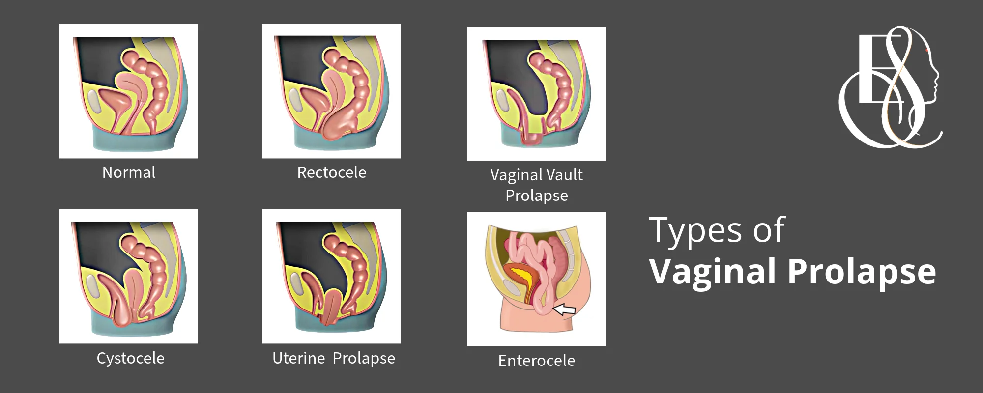 Vaginal Prolapse, Elle Sante, Reconstructive & Cosmetic Gynaecology